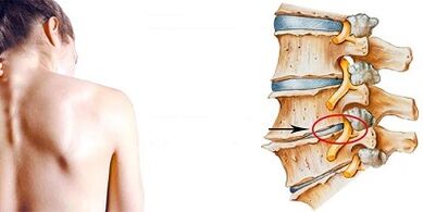 Mechanizmus rozvoja krčnej osteochondrózy