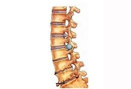 Štádiá rozvoja krčnej osteochondrózy