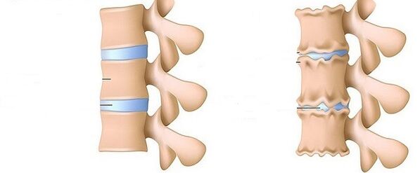 Zdravá chrbtica a osteochondróza