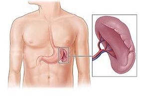 patológia sleziny ako príčina bolesti pod ľavou lopatkou