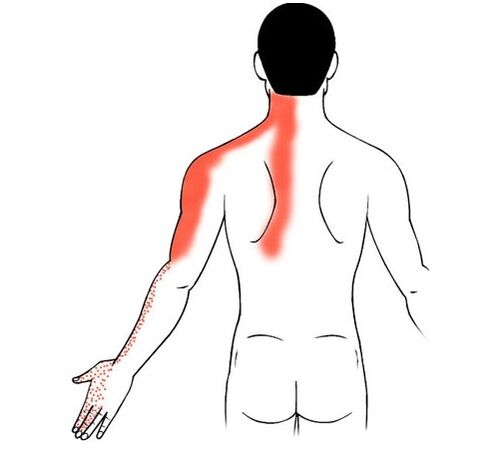 cervikálna osteochondróza ako príčina bolesti v kĺboch ​​prstov
