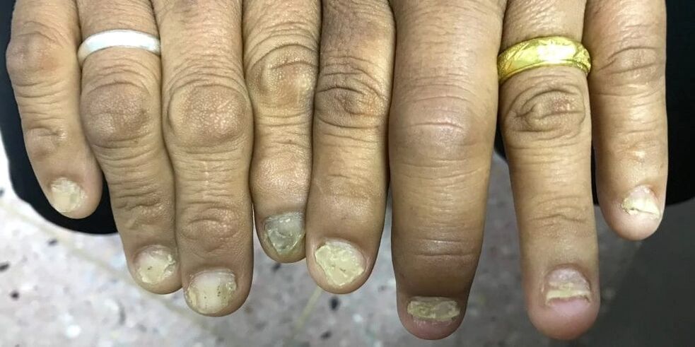 Opuch prstov a deformácia nechtovej platničky môže naznačovať rozvoj psoriatickej artritídy